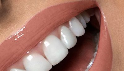 تبييض الأسنان والتخلص من الجير بطريقة آمنة
